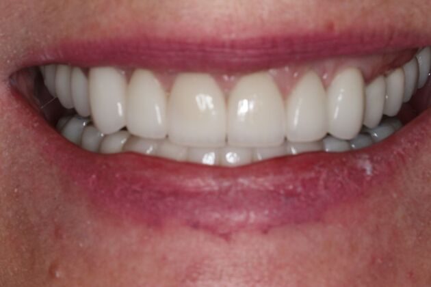 Dental Crowns: Case 35 - After
