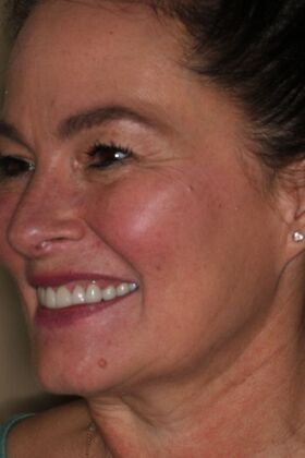 Dental Crowns: Case 35 - After