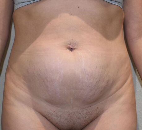Tummy Tuck (Abdominoplasty): Case 377 - Before