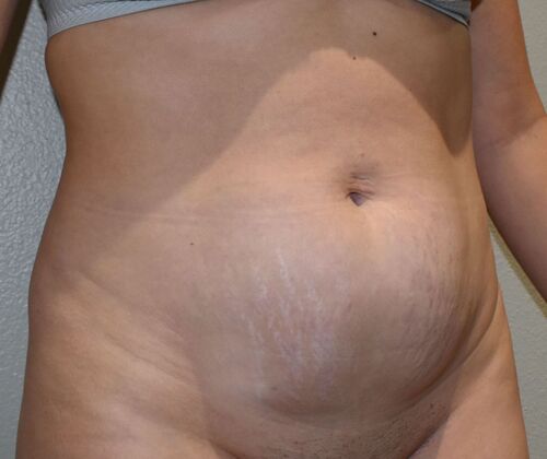 Tummy Tuck (Abdominoplasty): Case 377 - Before