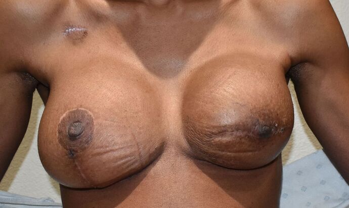 Breast Reconstruction Case 79 - After
