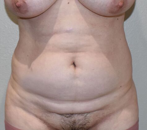Tummy Tuck (Abdominoplasty): Case 378 - Before