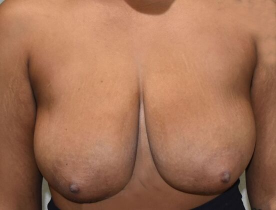 Breast Lift (Mastopexy) Case 151 - Before
