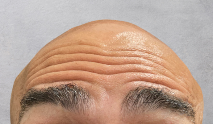 Botox Case 1 - Before