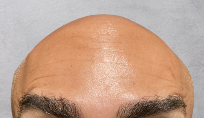 Botox Case 1 - After