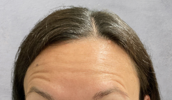 Botox Case 2 - Before