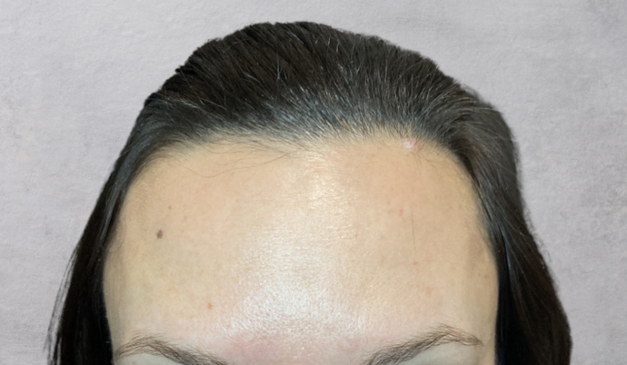 Botox Case 2 - After