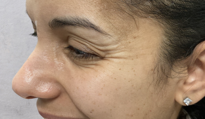 Botox Case 3 - Before