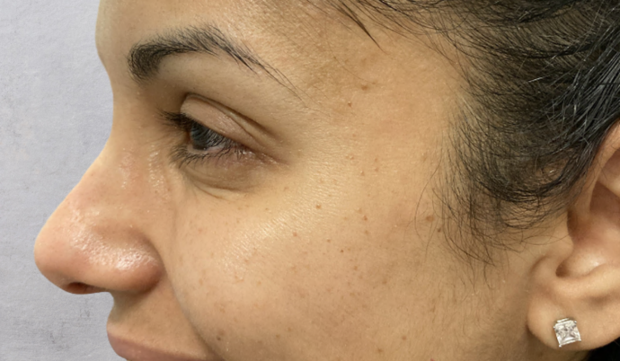 Botox Case 3 - After