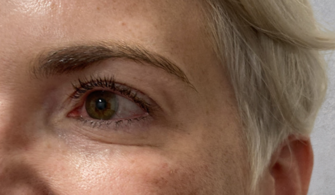 Botox Case 4 - After