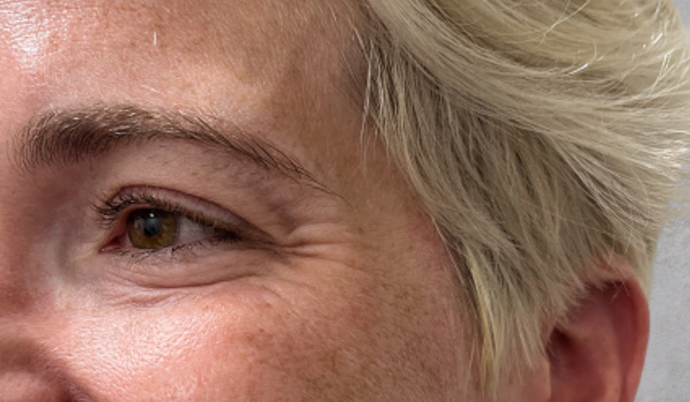 Botox Case 4 - Before