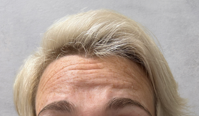 Botox: Case 4 - Before