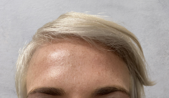 Botox: Case 4 - After