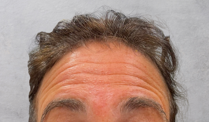 Botox Case 5 - Before