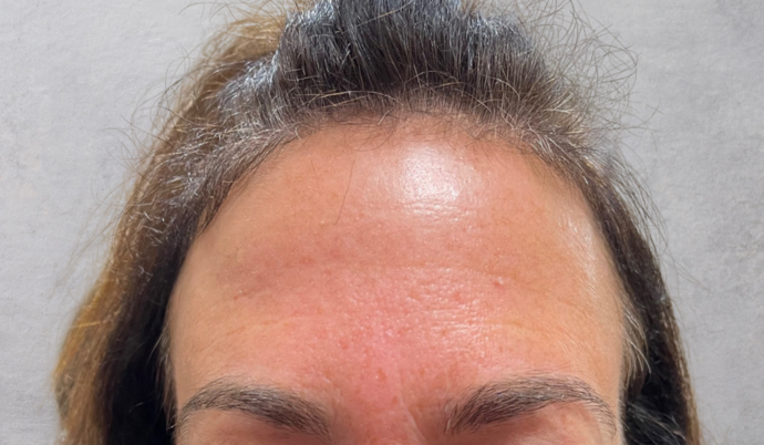 Botox Case 5 - After