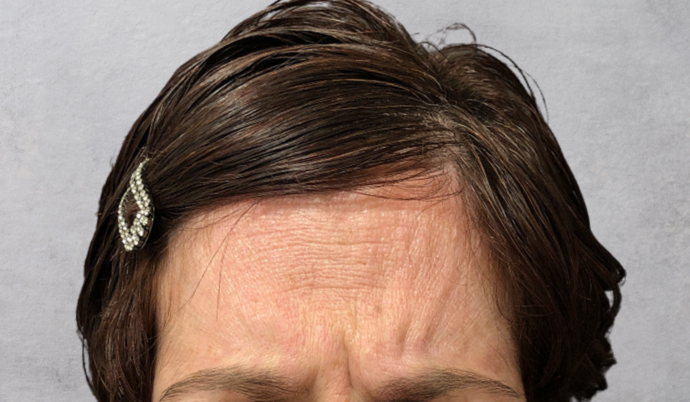 Botox Case 6 - Before