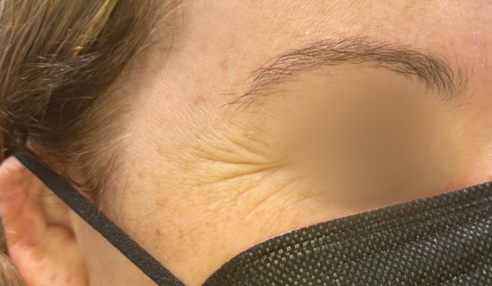 Botox: Case 8 - Before