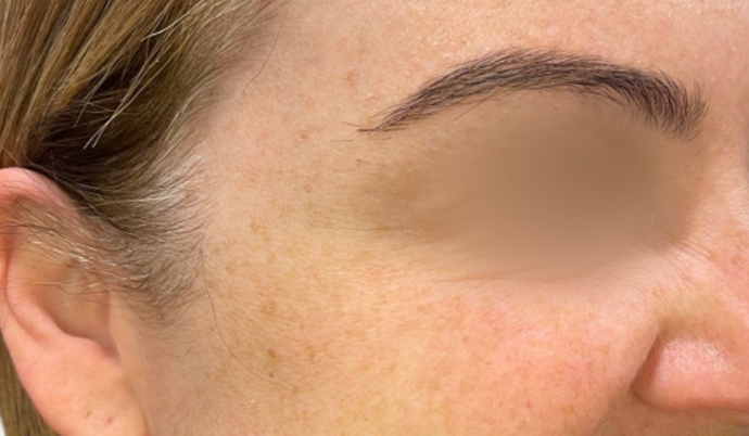 Botox: Case 8 - After