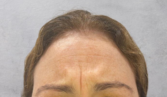 Botox Case 8 - Before