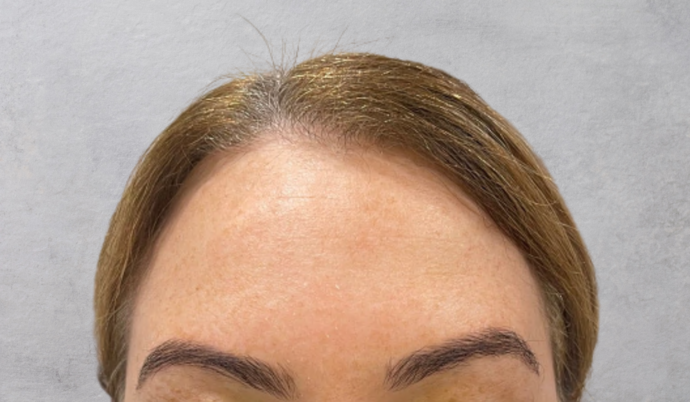 Botox Case 8 - After