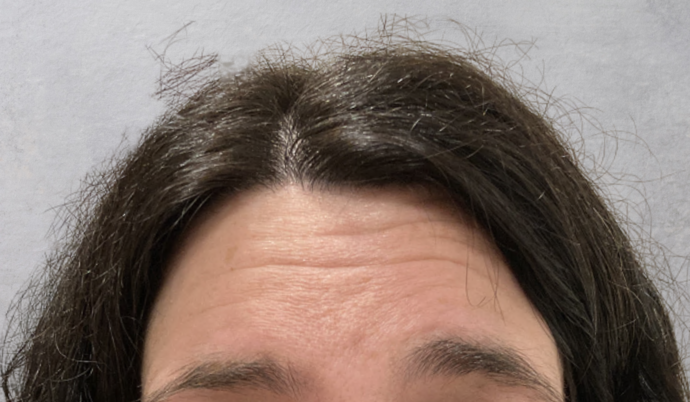 Botox Case 9 - Before