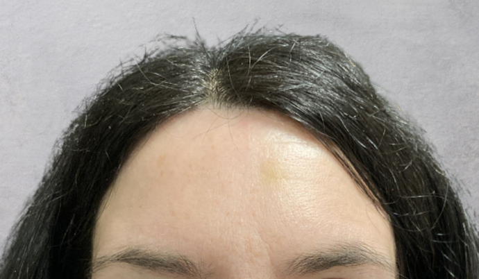 Botox Case 9 - After