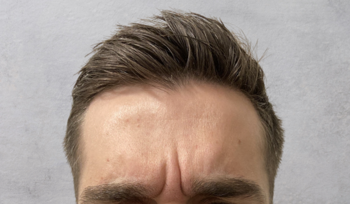 Botox Case 10 - Before