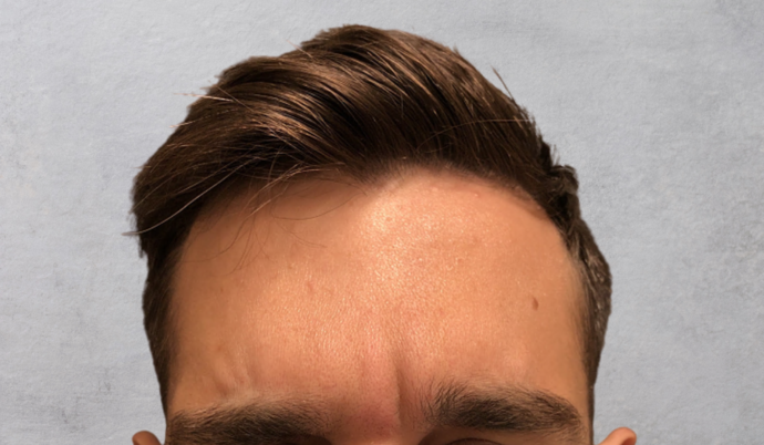 Botox Case 10 - After