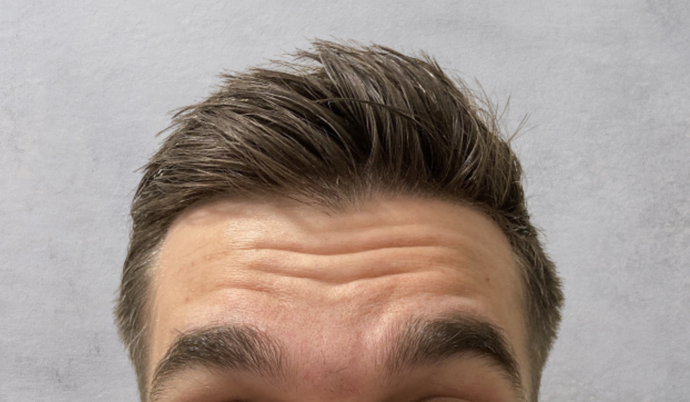 Botox: Case 10 - Before