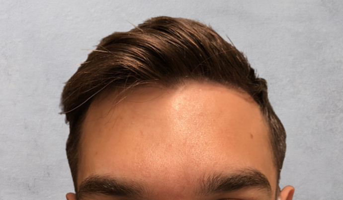 Botox: Case 10 - After