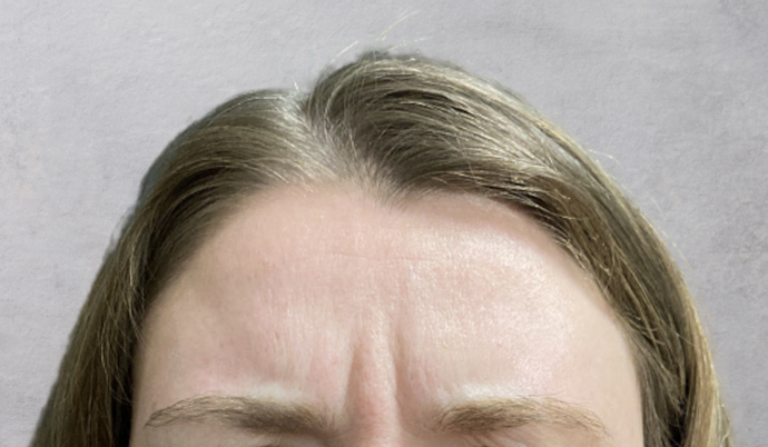 Botox: Case 11 - Before