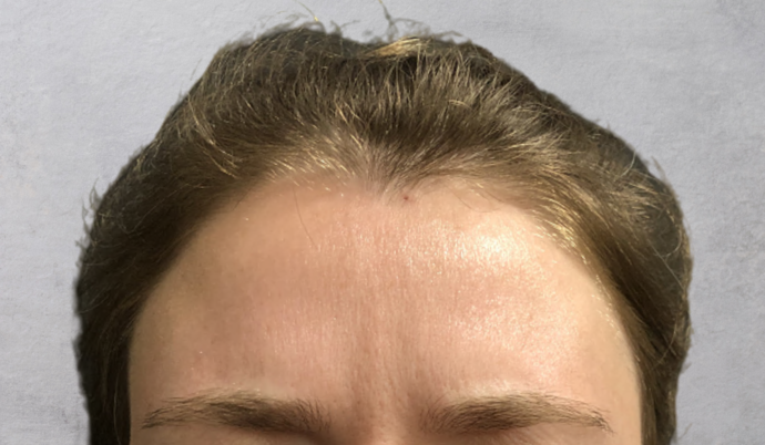 Botox: Case 11 - After