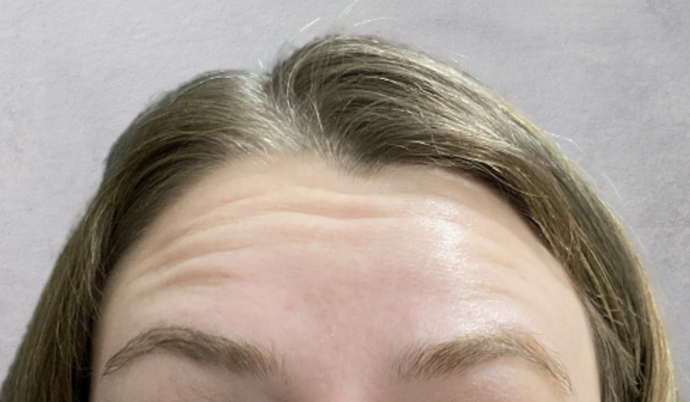 Botox Case 11 - Before