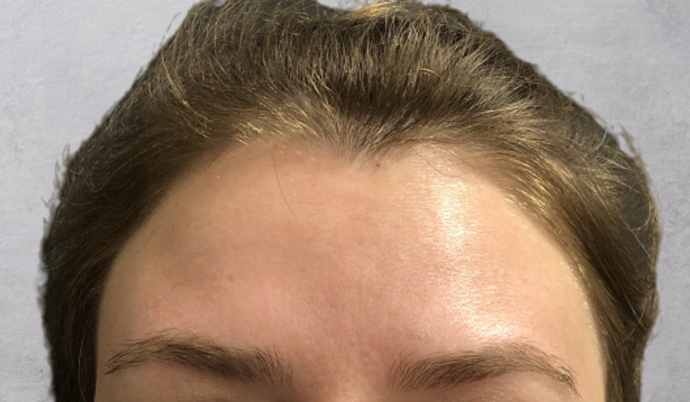 Botox Case 11 - After
