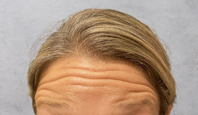 Botox Case 12 - Before