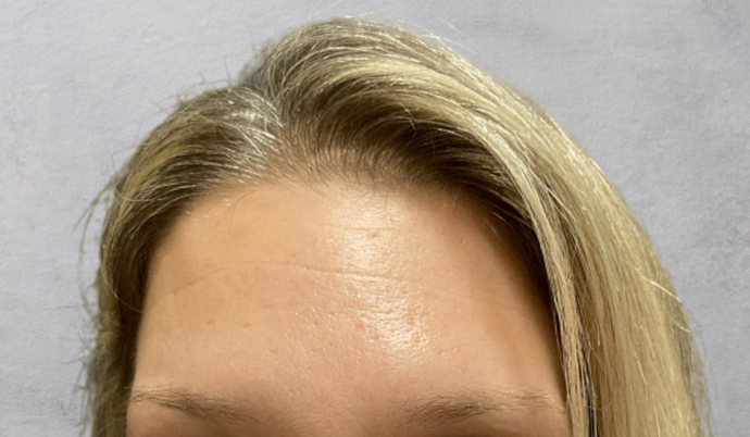 Botox Case 12 - After