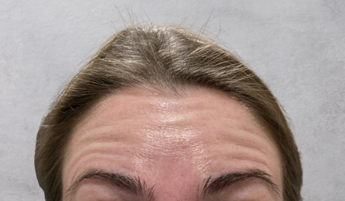 Botox Case 13 - Before