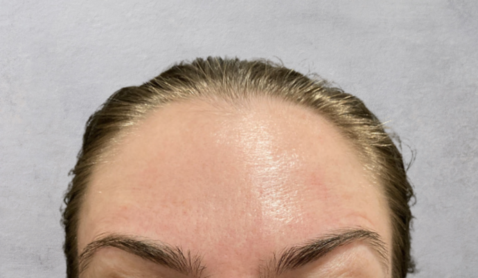 Botox Case 13 - After