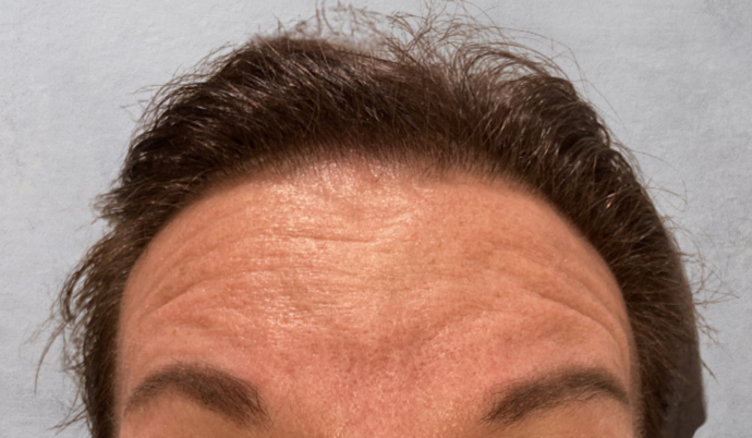 Botox Case 7 - Before