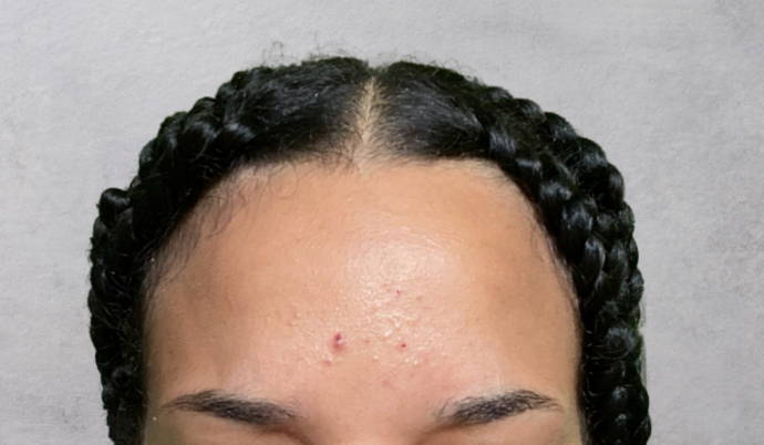 Botox: Case 14 - After