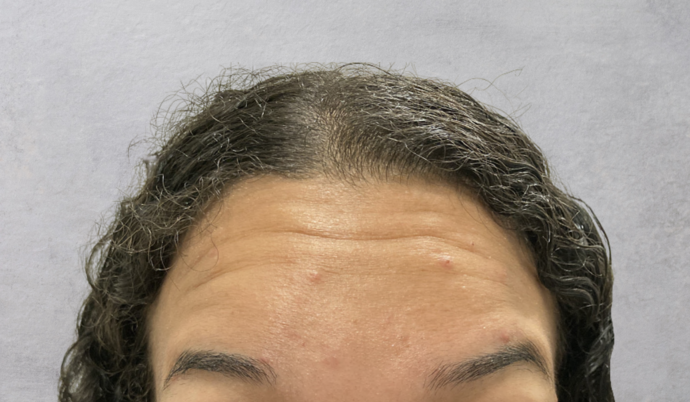 Botox Case 14 - After