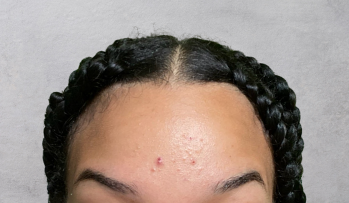 Botox Case 14 - Before