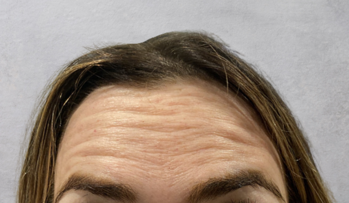 Botox Case 15 - Before