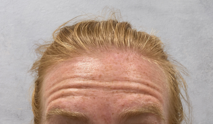 Botox: Case 16 - Before