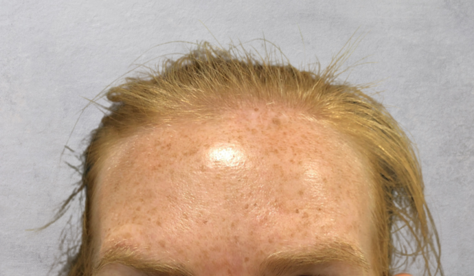 Botox: Case 16 - After