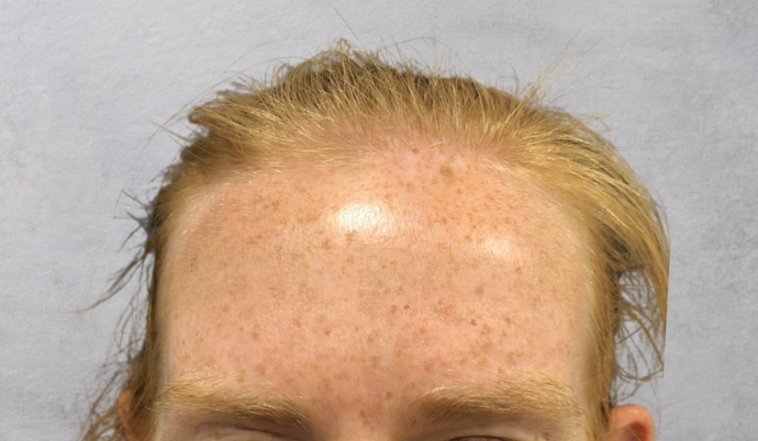 Botox Case 16 - After