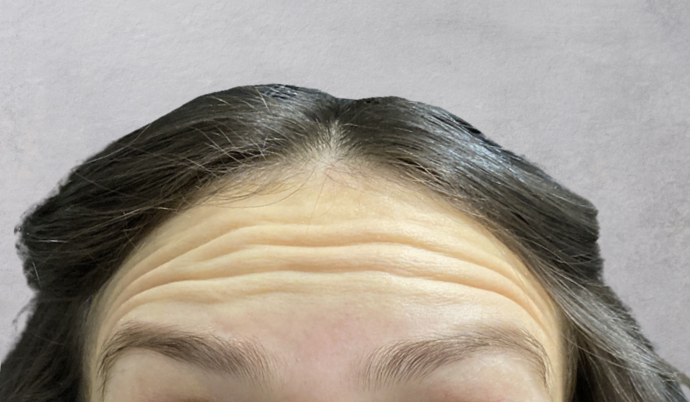 Botox Case 17 - Before