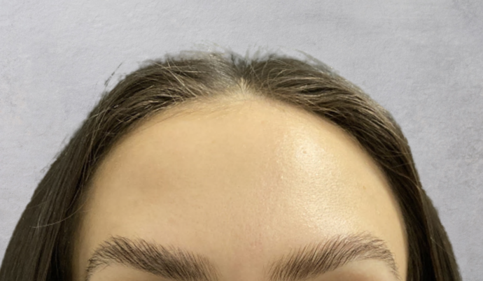 Botox Case 17 - After