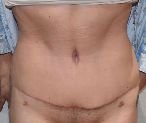 Tummy Tuck (Abdominoplasty): Case 369 - After