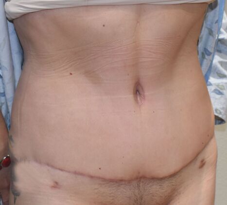 Tummy Tuck (Abdominoplasty): Case 369 - After